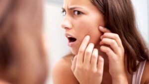 4 remedios naturales para el acné
