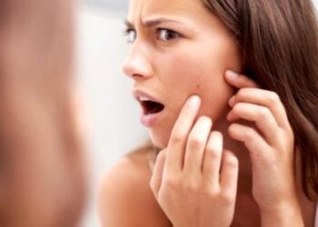 4 remedios naturales para el acné